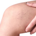 Escleroterapia l&iacute;quida ou espuma