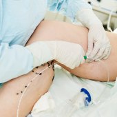 Cirurgia de varizes por Radiofr&ecirc;quencia (abla&ccedil;&atilde;o)